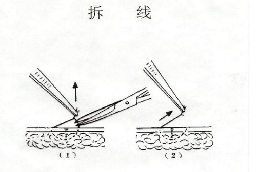 拆线.jpg