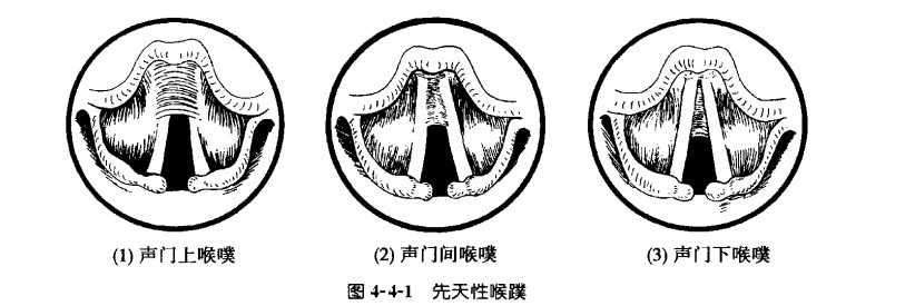 先天性喉蹼.jpg