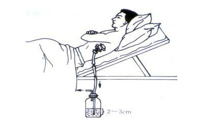 胸腔闭式引流术.jpg