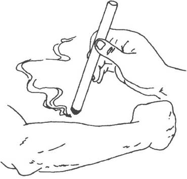 温和灸示意图