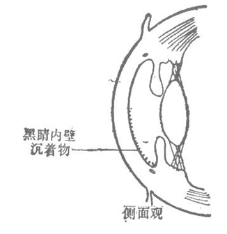 黑睛內壁沉着物-側面觀