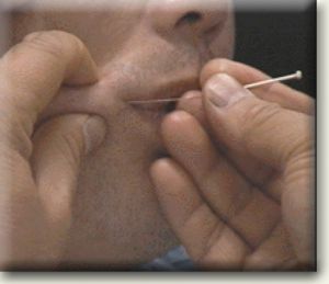 直针刺法示意图