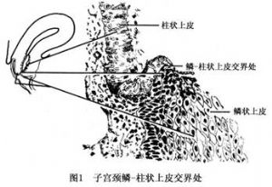 圖1 子宮頸鱗-柱狀上皮交界處