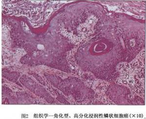 圖2 組織學-角化型、高分化浸潤性鱗狀細胞癌
