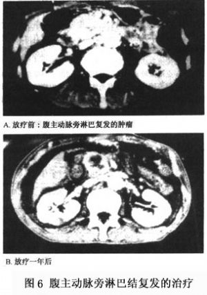 圖6 腹主動脈旁淋巴結復發的治療