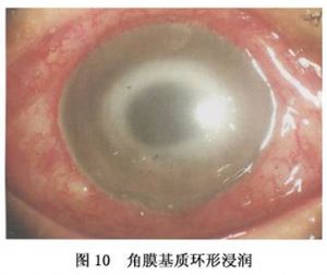 角膜基质环形浸润