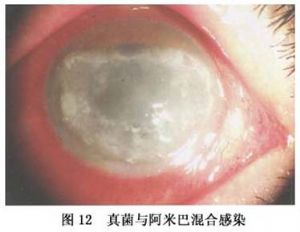 真菌与阿米巴混合感染