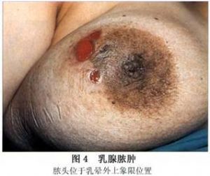 乳腺膿腫 濃頭位於乳暈外上象限位置