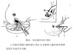 乳房膿腫切開引流