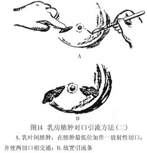 乳房膿腫對口引流方法