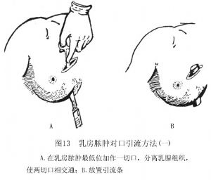 乳房膿腫對口引流方法