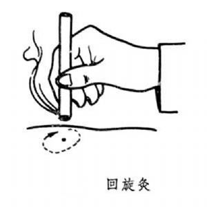 迴旋灸示意圖