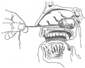 牵引锥形纱球使进入后鼻孔 牵引锥形纱球使进入后鼻孔