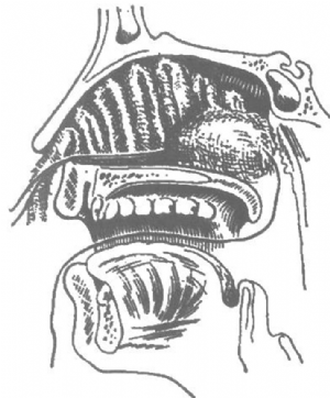 用凡士林纱条作前鼻孔填塞 用凡士林纱条作前鼻孔填塞