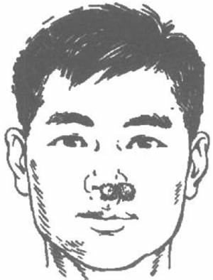 将系于纱球之引线固定于鼻前孔 将系于纱球之引线固定于鼻前孔