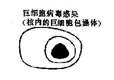 病毒感染时,痰涂片中的细胞内包涵体