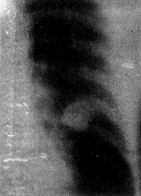 左肺外围型肺癌