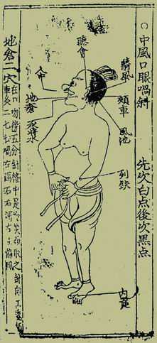 《针灸捷径》