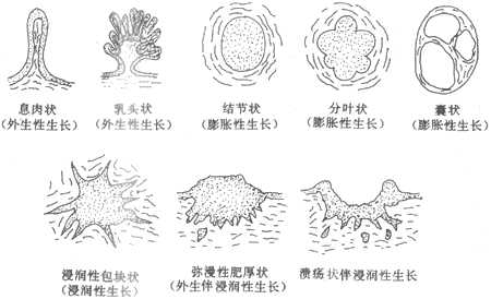 肿瘤的外形和生长方式模式图