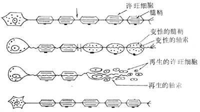 Waller变性模式图　（采自Escourolle）