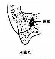 乳突类型