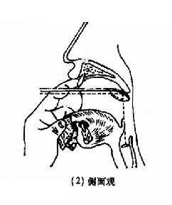 间接喉镜检查法