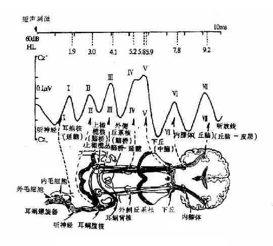 听性脑干反应典型七个波及来源示意图