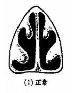 鼻中隔偏曲的类型