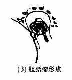 胆脂瘤形成示意图
