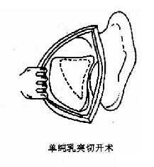 乳突手术类型