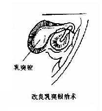 乳突手术类型