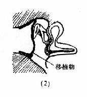 鼓室成形术