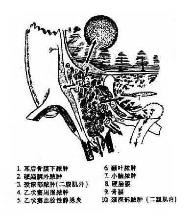 耳源性并发症扩散示意图
