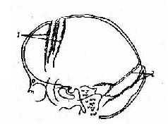 儿童颅内高压所致颅缝分离