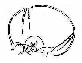 侧位片显示鞍上颅咽管瘤钙化及颅缝增宽