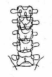 正位，椎弓根距离增大