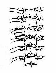 正位，椎旁软组织块影