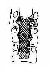髓内肿瘤上行碘油造影