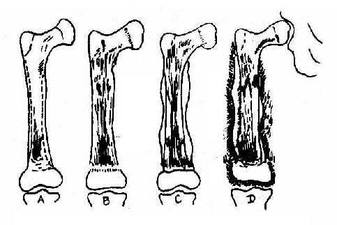 股骨急性血源性化脓性骨髓炎的病程各阶段改变