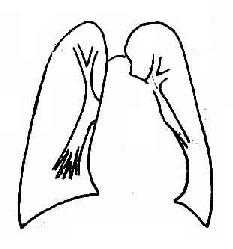 房间隔缺损，并发肺循环高压