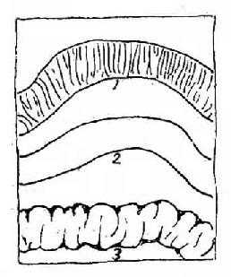 胀气肠管示意图