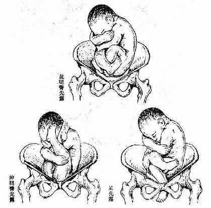 臀位,均为骶左后