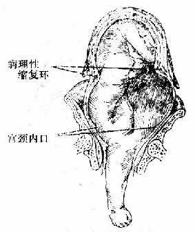疏忽性横位,病理性缩复环形成
