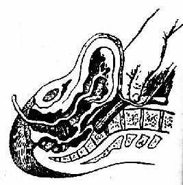 压迫腹主动脉止血