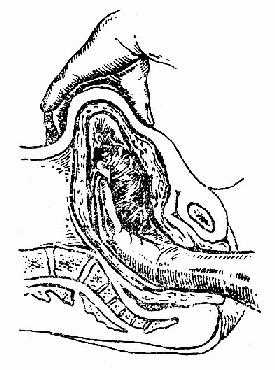 手取胎盘示意图