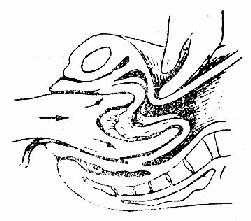 内翻子宫复位示意图