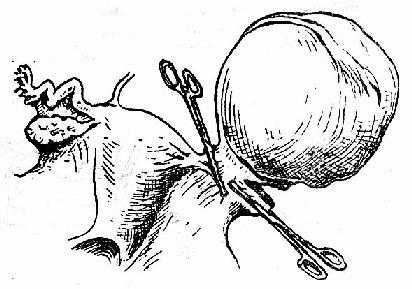 切除卵巢肿瘤示意图