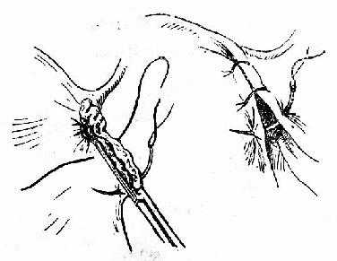 缝扎蒂部及缝合阔韧带前后以覆盖粗糙面