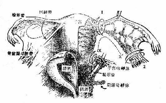 切除子宫时主要血管的缝扎部位