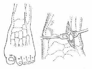 踝关节前外侧切开引流